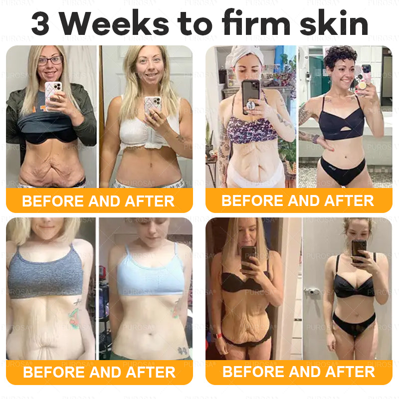 𝑷𝑼𝑹𝑶𝑺𝑨® 𝘽𝙀𝙀 𝙑𝙀𝙉𝙊𝙈 𝙎𝙠𝙞𝙣 𝙍𝙚𝙨𝙩𝙤𝙧𝙖𝙩𝙞𝙤𝙣 𝘾𝙧𝙚𝙖𝙢 –🍀 Anti-aging,Hydrating, Skin Repair, Even Tone, Acne and Dark Spot Treatment, Wart and Mole Removal, Psoriasis Relief