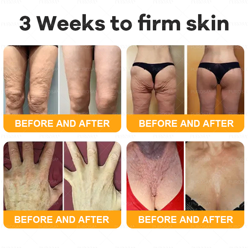 𝑷𝑼𝑹𝑶𝑺𝑨® 𝘽𝙀𝙀 𝙑𝙀𝙉𝙊𝙈 𝙎𝙠𝙞𝙣 𝙍𝙚𝙨𝙩𝙤𝙧𝙖𝙩𝙞𝙤𝙣 𝘾𝙧𝙚𝙖𝙢 –🍀 Anti-aging,Hydrating, Skin Repair, Even Tone, Acne and Dark Spot Treatment, Wart and Mole Removal, Psoriasis Relief