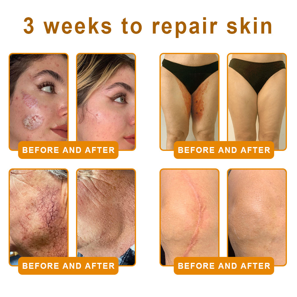 𝑷𝑼𝑹𝑶𝑺𝑨® 𝘽𝙀𝙀 𝙑𝙀𝙉𝙊𝙈 𝙎𝙠𝙞𝙣 𝙍𝙚𝙨𝙩𝙤𝙧𝙖𝙩𝙞𝙤𝙣 𝘾𝙧𝙚𝙖𝙢 –🍀 Anti-aging,Hydrating, Skin Repair, Even Tone, Acne and Dark Spot Treatment, Wart and Mole Removal, Psoriasis Relief