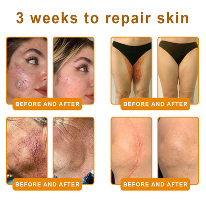 𝑷𝑼𝑹𝑶𝑺𝑨® 𝘽𝙀𝙀 𝙑𝙀𝙉𝙊𝙈 𝙎𝙠𝙞𝙣 𝙍𝙚𝙨𝙩𝙤𝙧𝙖𝙩𝙞𝙤𝙣 𝘾𝙧𝙚𝙖𝙢 –🍀 Anti-aging,Hydrating, Skin Repair, Even Tone, Acne and Dark Spot Treatment, Wart and Mole Removal, Psoriasis Relief