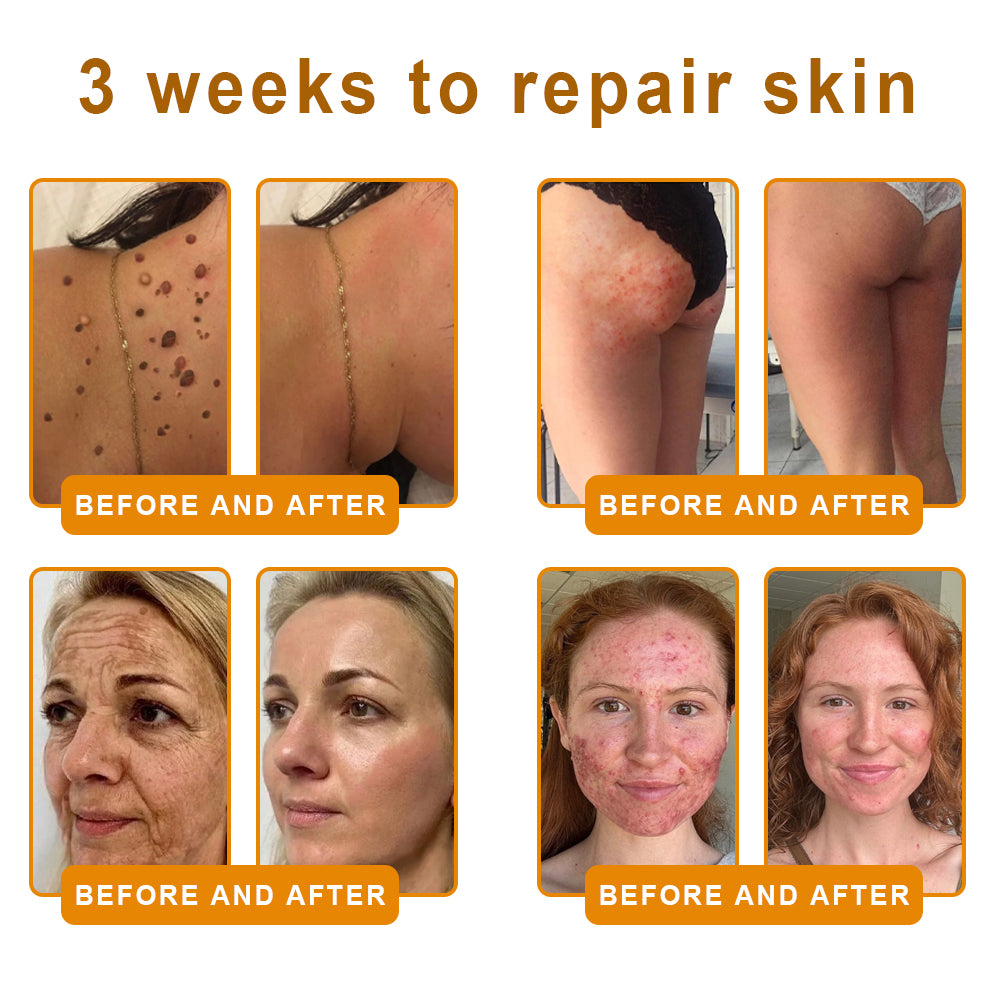 𝑷𝑼𝑹𝑶𝑺𝑨® 𝘽𝙀𝙀 𝙑𝙀𝙉𝙊𝙈 𝙎𝙠𝙞𝙣 𝙍𝙚𝙨𝙩𝙤𝙧𝙖𝙩𝙞𝙤𝙣 𝘾𝙧𝙚𝙖𝙢 –🍀 Anti-aging,Hydrating, Skin Repair, Even Tone, Acne and Dark Spot Treatment, Wart and Mole Removal, Psoriasis Relief