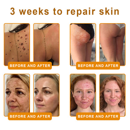 𝑷𝑼𝑹𝑶𝑺𝑨® 𝘽𝙀𝙀 𝙑𝙀𝙉𝙊𝙈 𝙎𝙠𝙞𝙣 𝙍𝙚𝙨𝙩𝙤𝙧𝙖𝙩𝙞𝙤𝙣 𝘾𝙧𝙚𝙖𝙢 –🍀 Anti-aging,Hydrating, Skin Repair, Even Tone, Acne and Dark Spot Treatment, Wart and Mole Removal, Psoriasis Relief