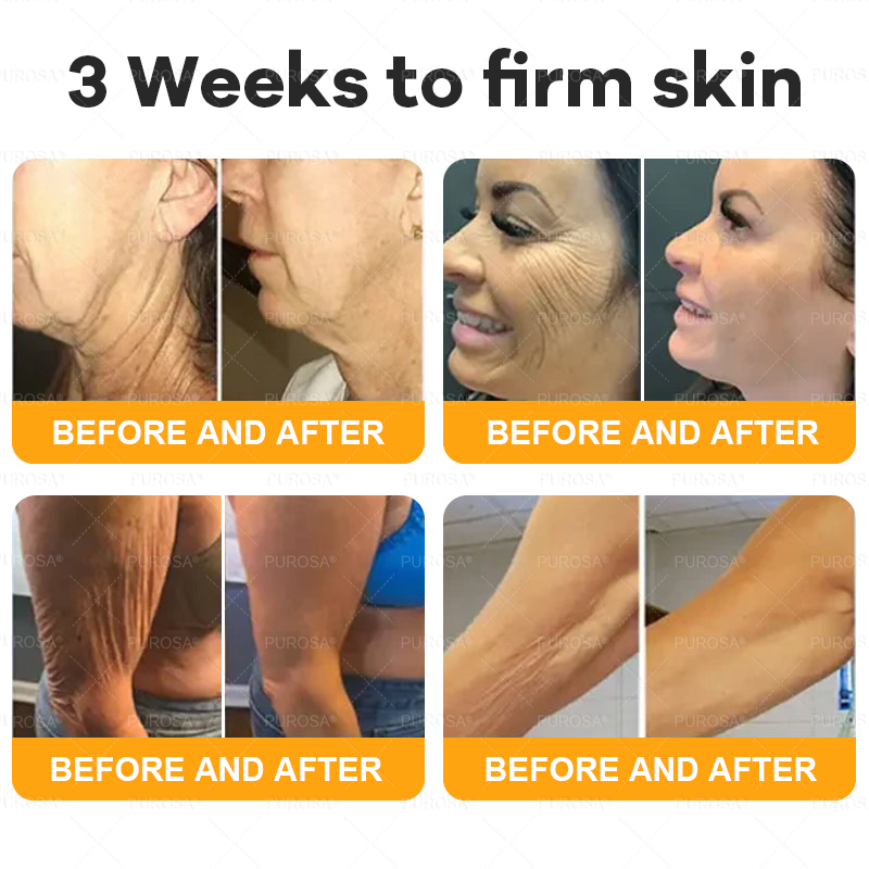 𝑷𝑼𝑹𝑶𝑺𝑨® 𝘽𝙀𝙀 𝙑𝙀𝙉𝙊𝙈 𝙎𝙠𝙞𝙣 𝙍𝙚𝙨𝙩𝙤𝙧𝙖𝙩𝙞𝙤𝙣 𝘾𝙧𝙚𝙖𝙢 –🍀 Anti-aging,Hydrating, Skin Repair, Even Tone, Acne and Dark Spot Treatment, Wart and Mole Removal, Psoriasis Relief